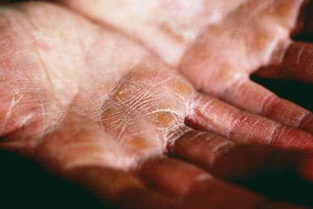 CBD Lotion For Eczema: The Answer To Your Eczema Prayers?